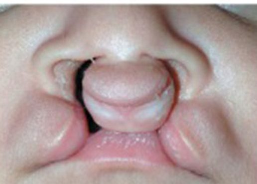 Fissura transforame bilateral