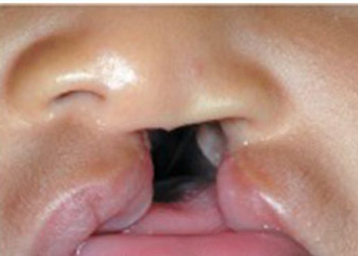 Fissura transforame unilateral
