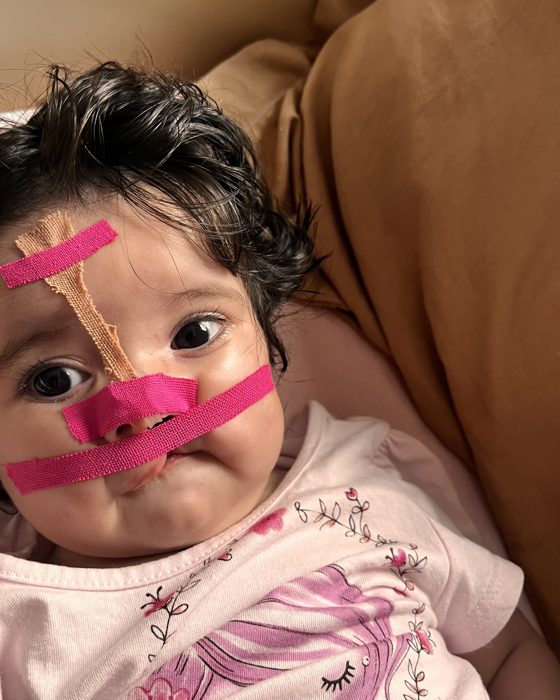 A Eulália usando o modelador nasal, preso com a fita rosa.